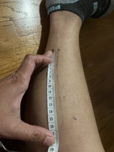 Melissa Roxas acupuncturist in Long Beach measures the calf muscle tear outlined by the sonologist
